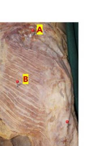 Gluteal dissection with muscles A and B marked