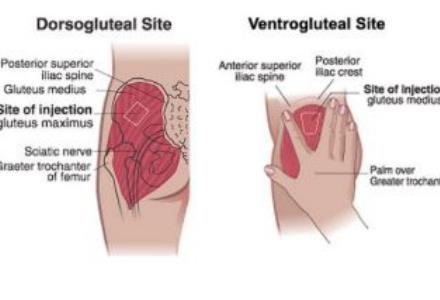 Ventrogluteal injection site over gluteus medius