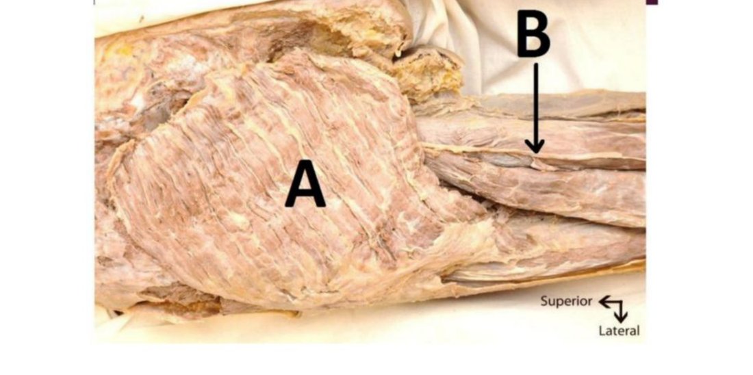 Gluteal/thigh dissection with muscle A and nerve B labelled