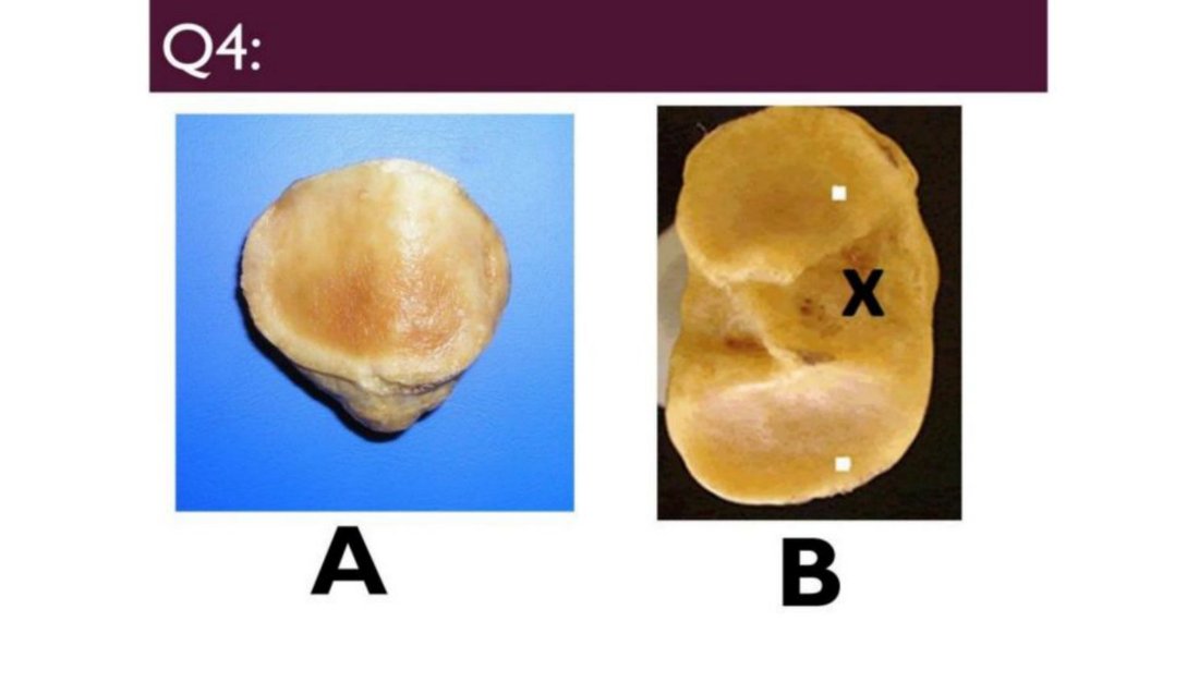 Tibial plateau specimen A and femoral condyle specimen B with region X