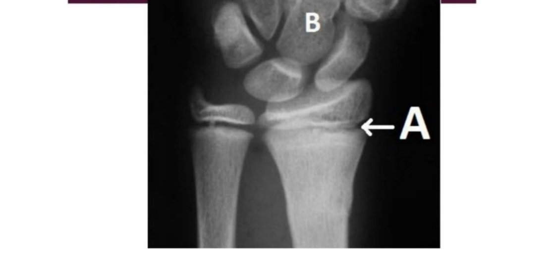 Wrist radiograph with A and B labelled