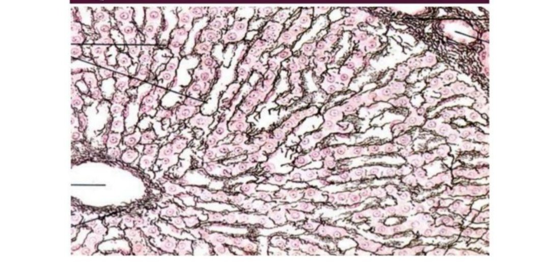 Silver-stained tissue showing reticular fibres around cell cords