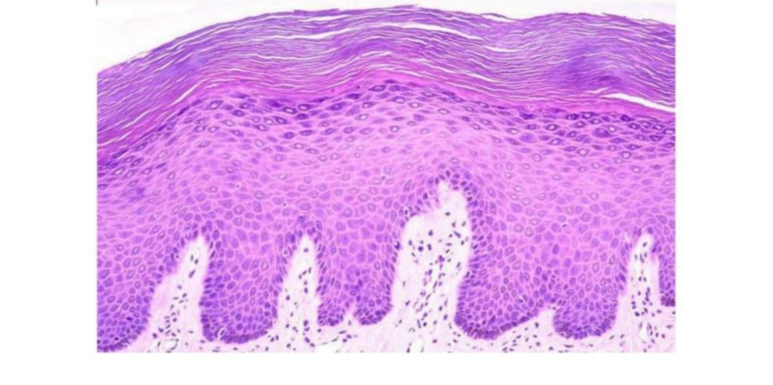 Photomicrograph of keratinized stratified squamous epithelium (skin)