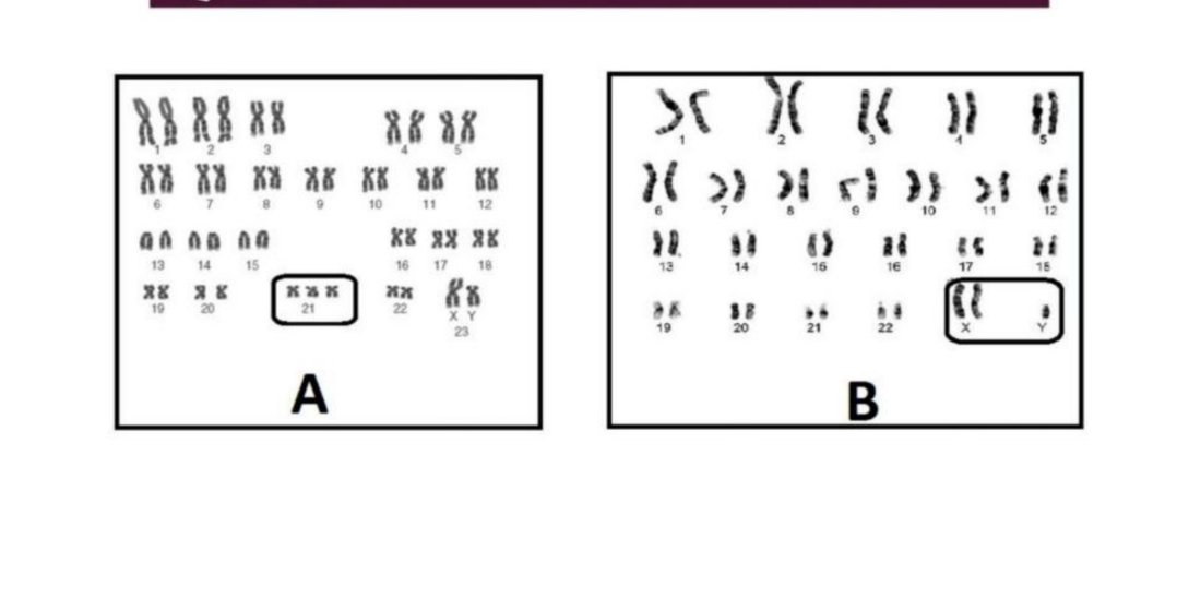 Two karyotypes, A showing trisomy 21 and B showing an extra sex chromosome