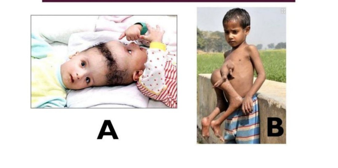 Two clinical photos of conjoined twin anomalies, A and B