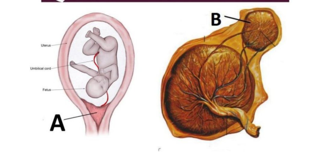 Diagram of a fetus with the umbilical cord, A, beside a placenta with an accessory lobe, B