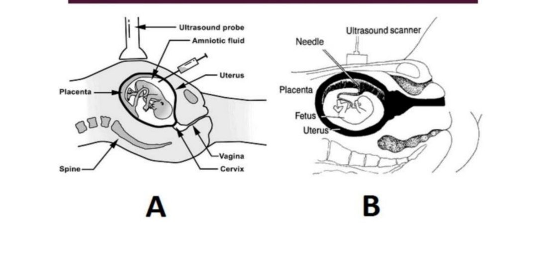 Diagrams of amniocentesis (A) and chorionic villus sampling (B)