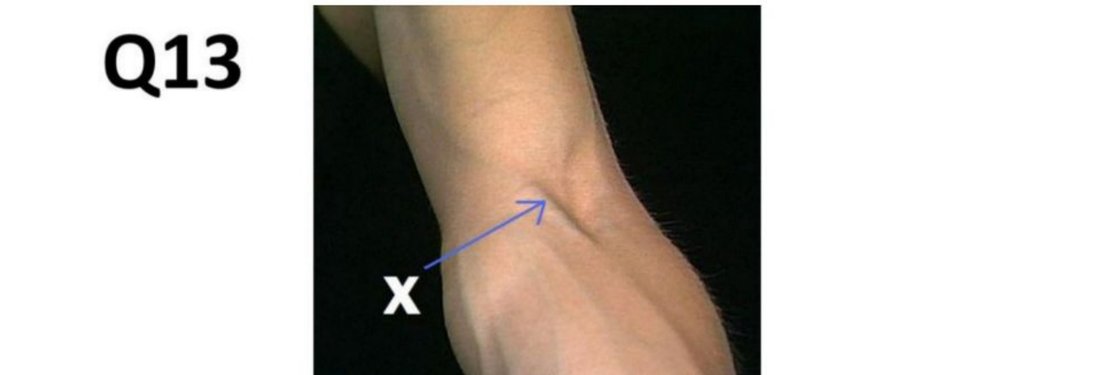 Q13 - back dissection with muscle F labelled