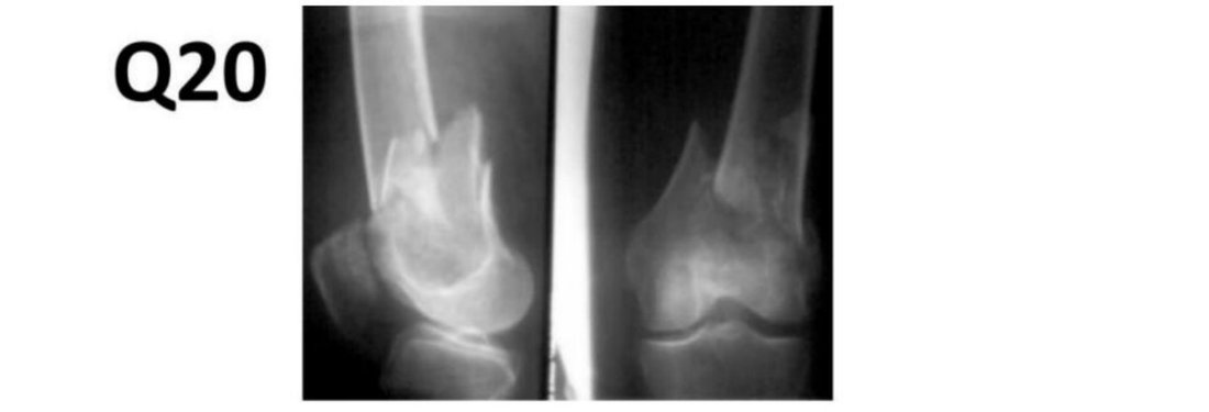 Q20 - knee X-ray, two views