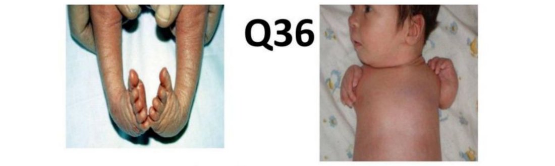 Q36 - clubfoot (A) and phocomelia (B) photos