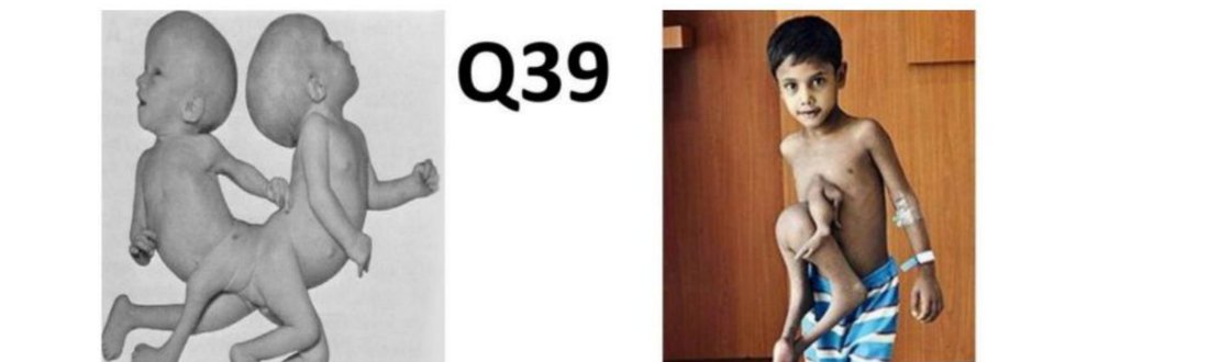 Q39 - conjoined twins (A) and a child with a parasitic twin (B)
