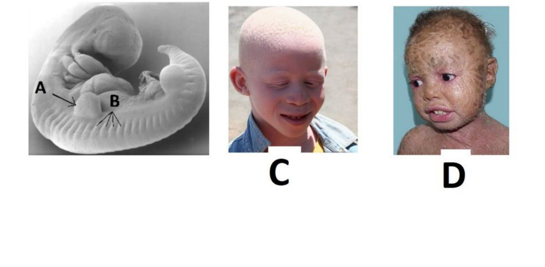 Embryo with limb bud (A) and somites (B) alongside photos of albinism (C) and a scaly-skin condition (D)