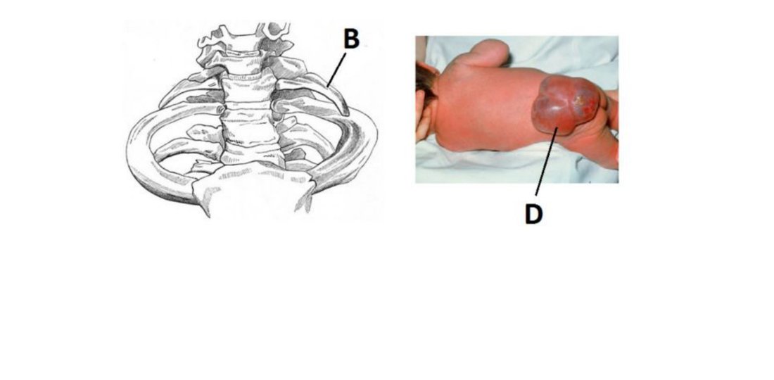 Cervical rib (B) on a skeleton and a soft-tissue swelling in a neonate (D)