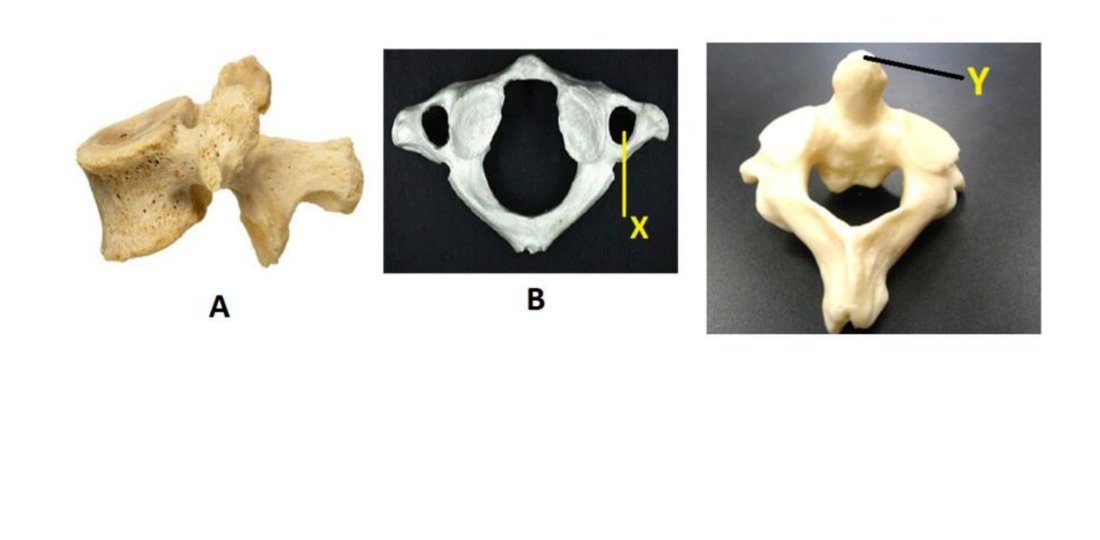Three vertebra specimens labelled A, B, with foramen X and process Y marked