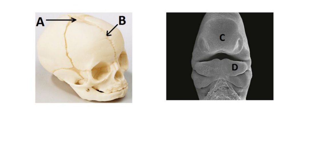 Infant skull showing fontanelles A, B and facial prominences C, D