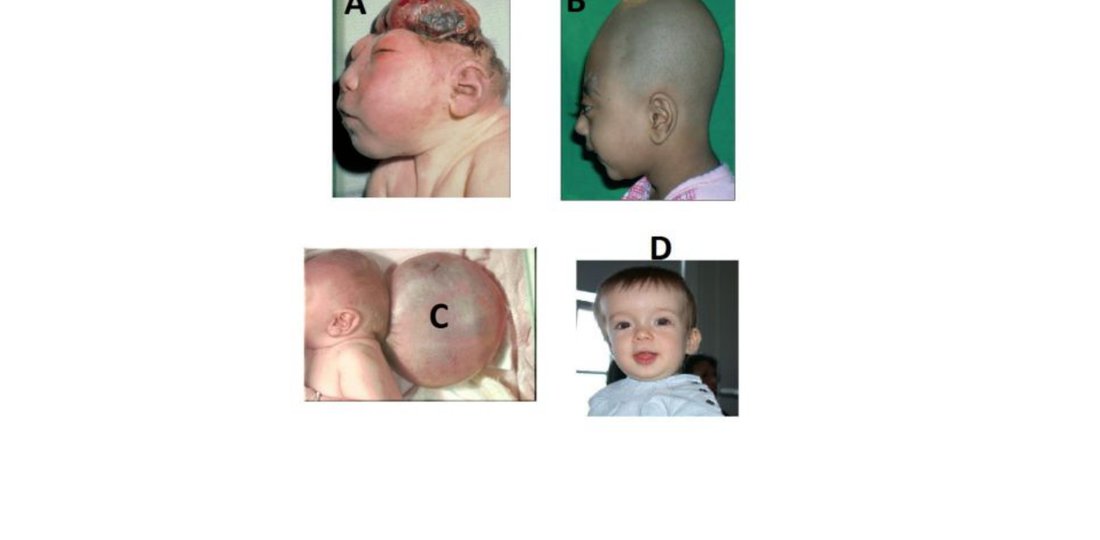 Four clinical photos of infants with skull/facial anomalies A, B, C, D