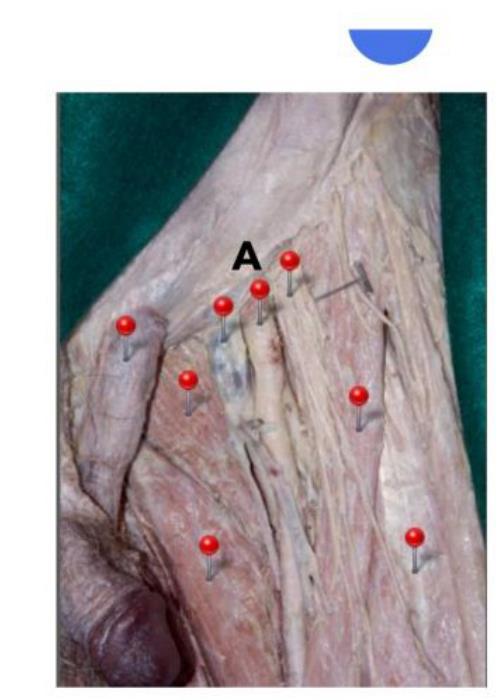 Femoral triangle dissection with structure A marked