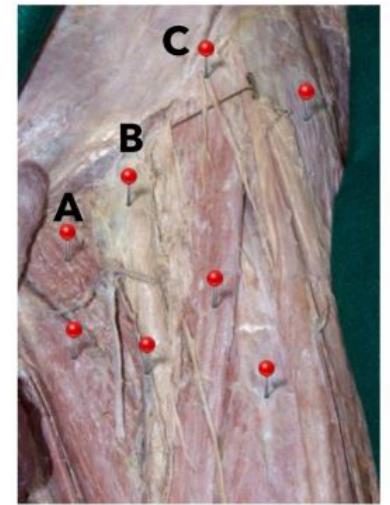 Femoral triangle dissection with A, B, and C tagged