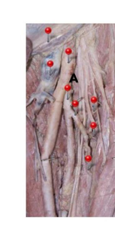 Posterior thigh dissection with artery A marked