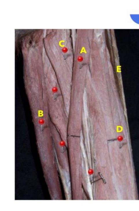 Anterior thigh dissection with A-E marked