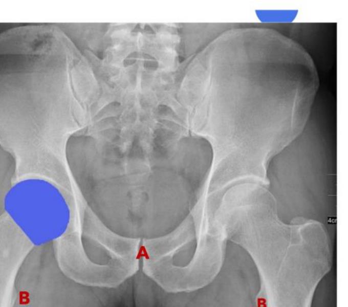 Pelvic radiograph with A and B marked