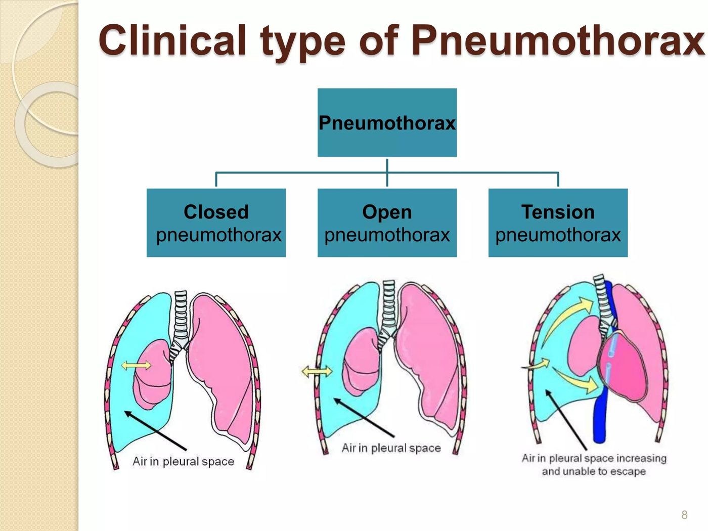 Clinical types of pneumothorax