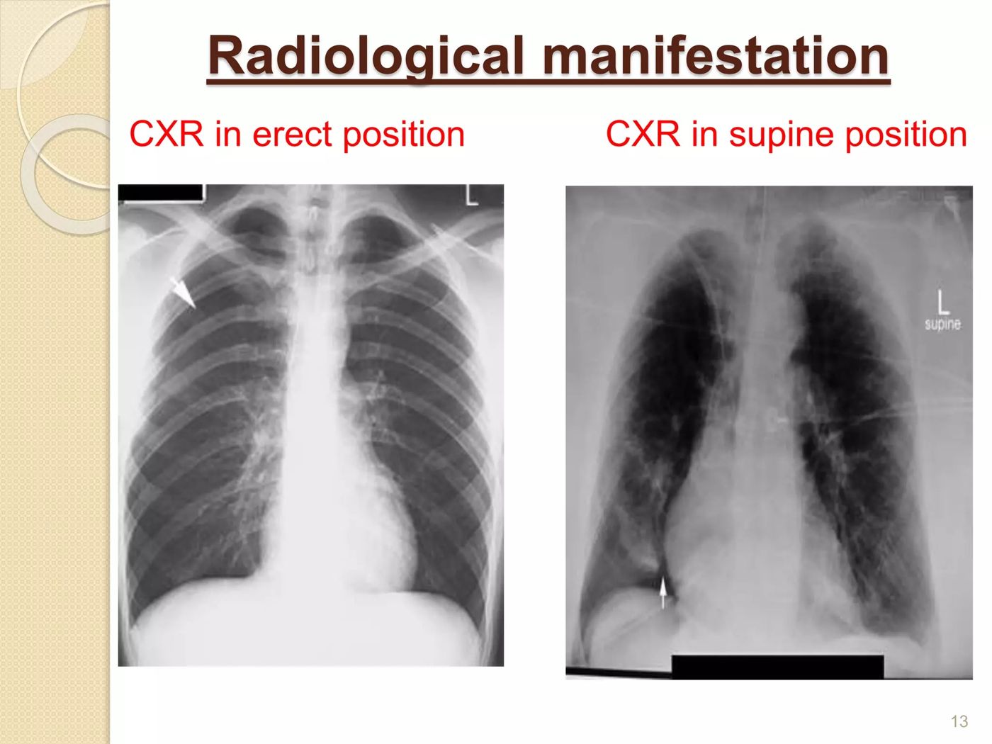 Chest X-ray in erect and supine positions