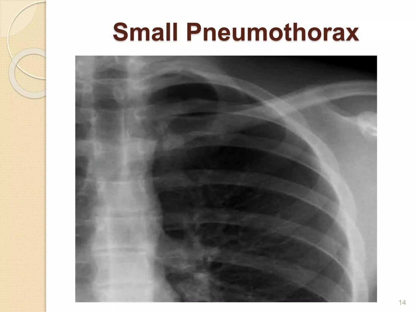 Small pneumothorax on chest X-ray