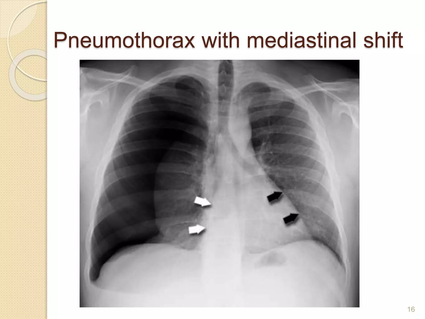 Pneumothorax with mediastinal shift