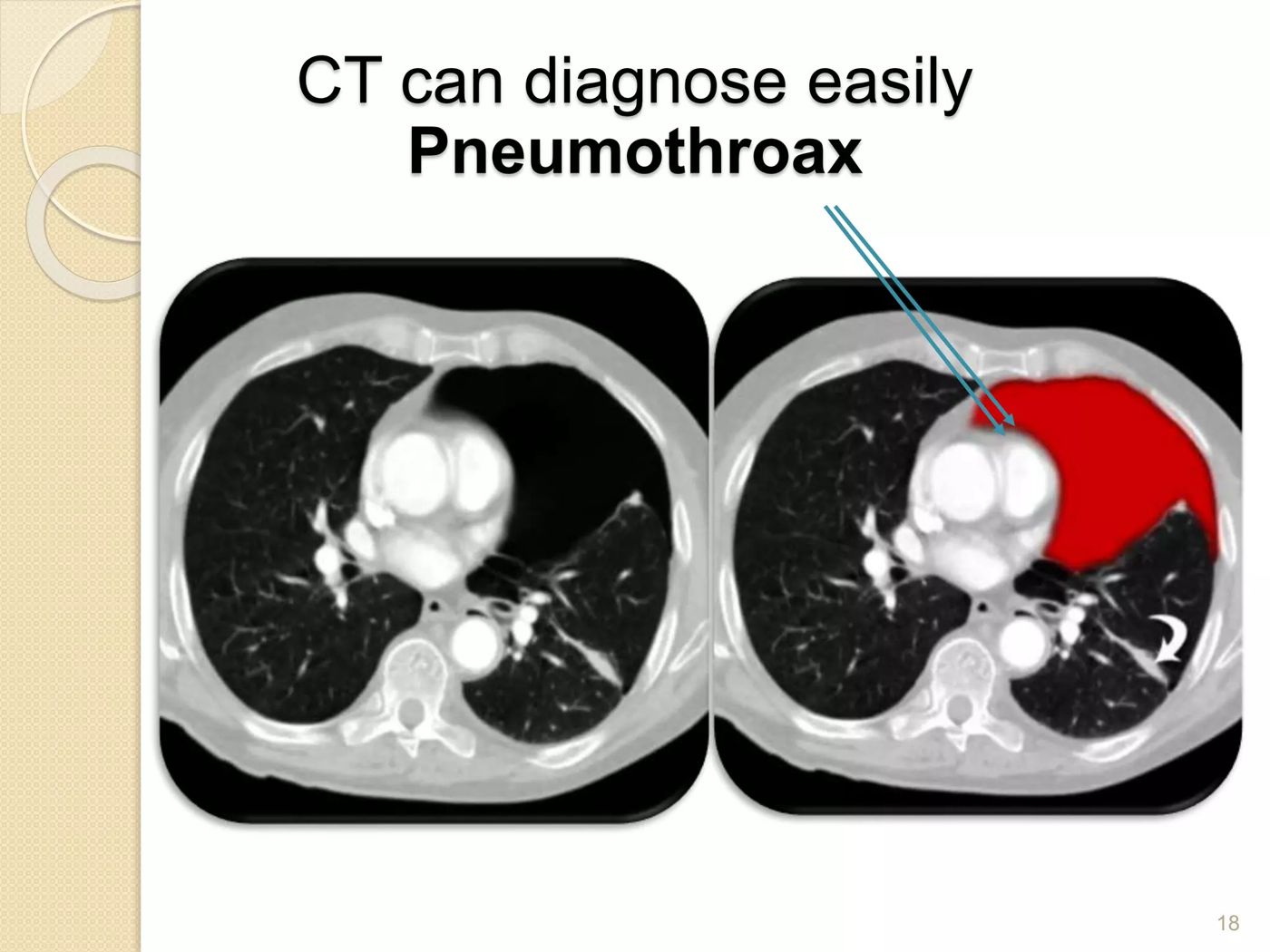 Pneumothorax on CT