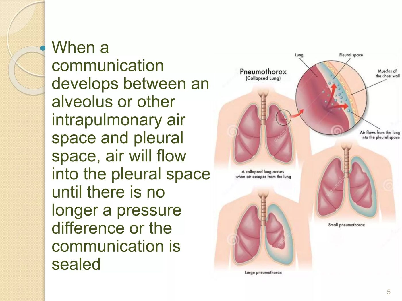 Air entering the pleural space — collapsed lung